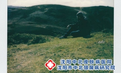 夏季怎样护理牛皮癣