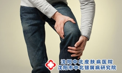 引发关节型牛皮癣的病因具体有哪些？