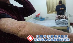 银屑病是湿气重吗？主任提醒：这5种关键点要明白