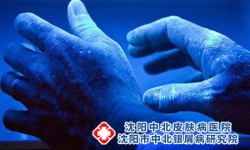 点滴型银屑病的消退期