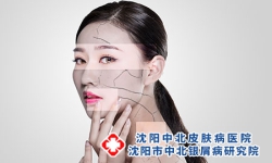 沈阳医生讲红皮病型牛皮癣的危害