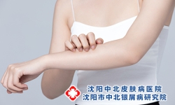 银屑病能恢复正常皮肤吗？