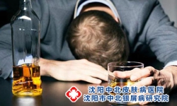 哪些人容易患牛皮癣？