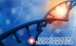 少年牛皮癣的遗传性 少年牛皮癣会遗传吗