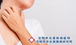 诱发牛皮癣的病因都有哪些