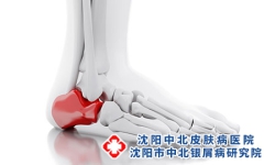 脚腕上有牛皮癣怎么治疗呢？