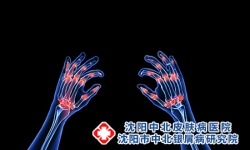 牛皮癣是因为身体有炎症吗？