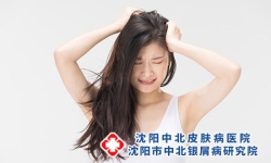 头部牛皮癣能治好吗？