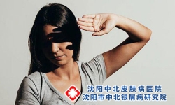 面部银屑病如何预防