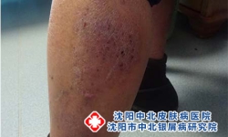 牛皮癣和银屑病是一种吗？医生说：这10个关键点要明白