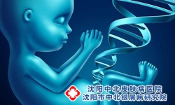 牛皮癣的遗传有什么规律
