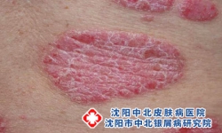 重度斑块型银屑病诊断标准与科学管理指南