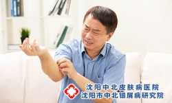 关于男子牛皮癣护理 三个调理事项很重要