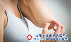 牛皮癣要和哪些疾病区分