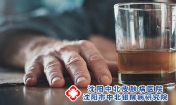 沈阳皮研所能不能治疗牛皮癣-沈阳治疗牛皮癣专业医院