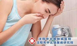 如何远离牛皮癣的危害?