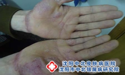 如何判断自己的银屑病是否属于严重类型?