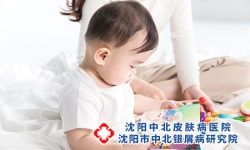牛皮癣传染婴幼儿吗?