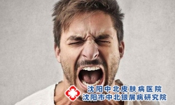 如何应对牛皮癣反复复发 3招预防牛皮癣复发