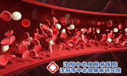 血热型牛皮癣对患者伤害严重么