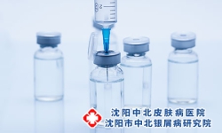 糖皮质激素治疗牛皮癣易发生不良反应
