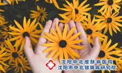 治疗牛皮癣要注意什么