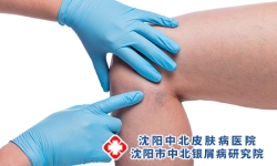 牛皮癣关节炎怎么治疗才好？