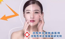 面部牛皮癣如何用药治疗呢?
