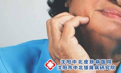 老年银屑病表现特征是什么?