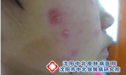 阴虚型银屑病如何调理？中医养生建议