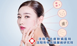 银屑病常用的润肤剂，应该如何选?