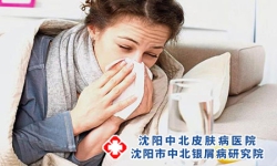哪些人比较容易得牛皮癣?