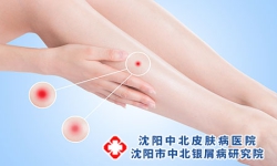 银屑病大量掉屑，如何温和去除？