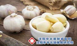 大蒜治疗牛皮癣的方法管用吗？