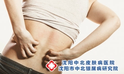 沈阳银屑病好的治疗医院：银屑病为什么会掉屑？