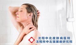 牛皮癣病人可以洗澡吗-要注意什么事项？