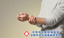 预防红皮型银屑病有什么方法？
