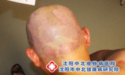 头部脂溢性皮炎和银屑病 两类头皮问题区分认知指南
