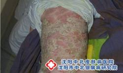 银屑病在治疗后为什么没有好转呢