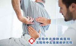 秋季怎样不让牛皮癣加重？