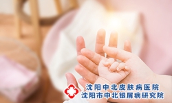 新生儿牛皮癣遗传吗