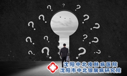 治疗沈阳牛皮癣的办法是什么呢
