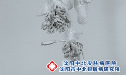 沈阳牛皮癣初期怎么办