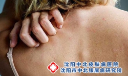 牛皮癣的初期症状有什么呢