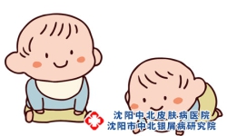 银屑病患者可以生二胎吗