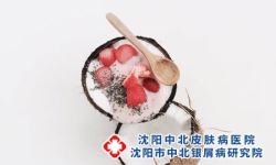 揭秘常规治疗外的“家庭疗法”，让银屑病不再可怕!沈阳银屑病医院