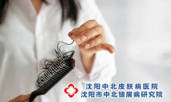 有牛皮癣会不会掉头发 头部牛皮癣的缓解方法