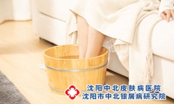 牛皮癣患者用热水泡脚有什么好处-三大好处帮你轻松搞定牛皮癣