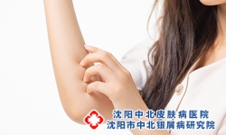 牛皮癣应如何止痒? 得了牛皮癣很痒应该怎么办