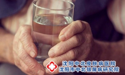牛皮癣要怎么治疗 牛皮癣患者不可用热水止痒